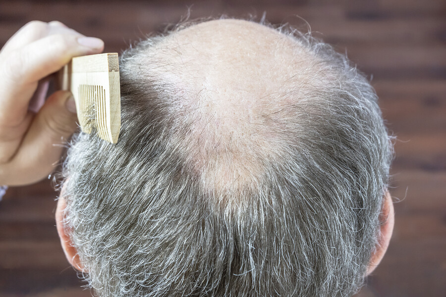 Haarausfall verhindern: Forscher entwickeln neue Methode gegen Glatzenbildung