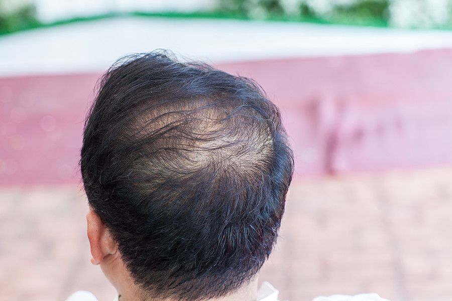 Haarausfall effektiv bekämpfen – so wirkt die Mesotherapie gegen Haarausfall