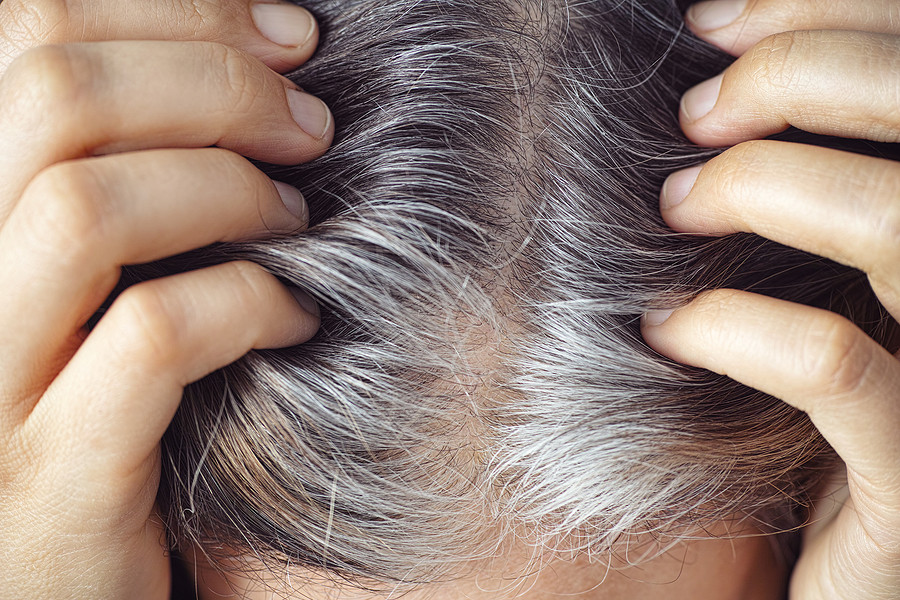 Schmerzhaft und unschön zu gleich – so ist Haarausfall durch eine Haarwurzelentzündung