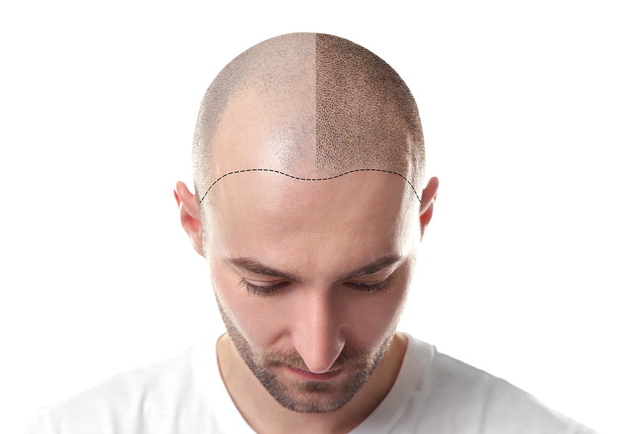 Haarpigmentierung und -Transplantation – wenn die Haarpracht nicht von Natur aus prächtig sein möchte