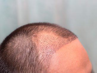 Korrektur einer Haarverpflanzung