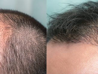 Haartransplantation ohne Rasur oder Haartransplantation mit Teilrasur