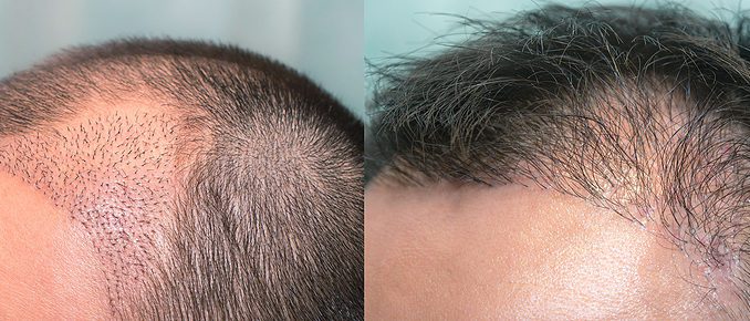 Haartransplantation ohne Rasur oder Haartransplantation mit Teilrasur