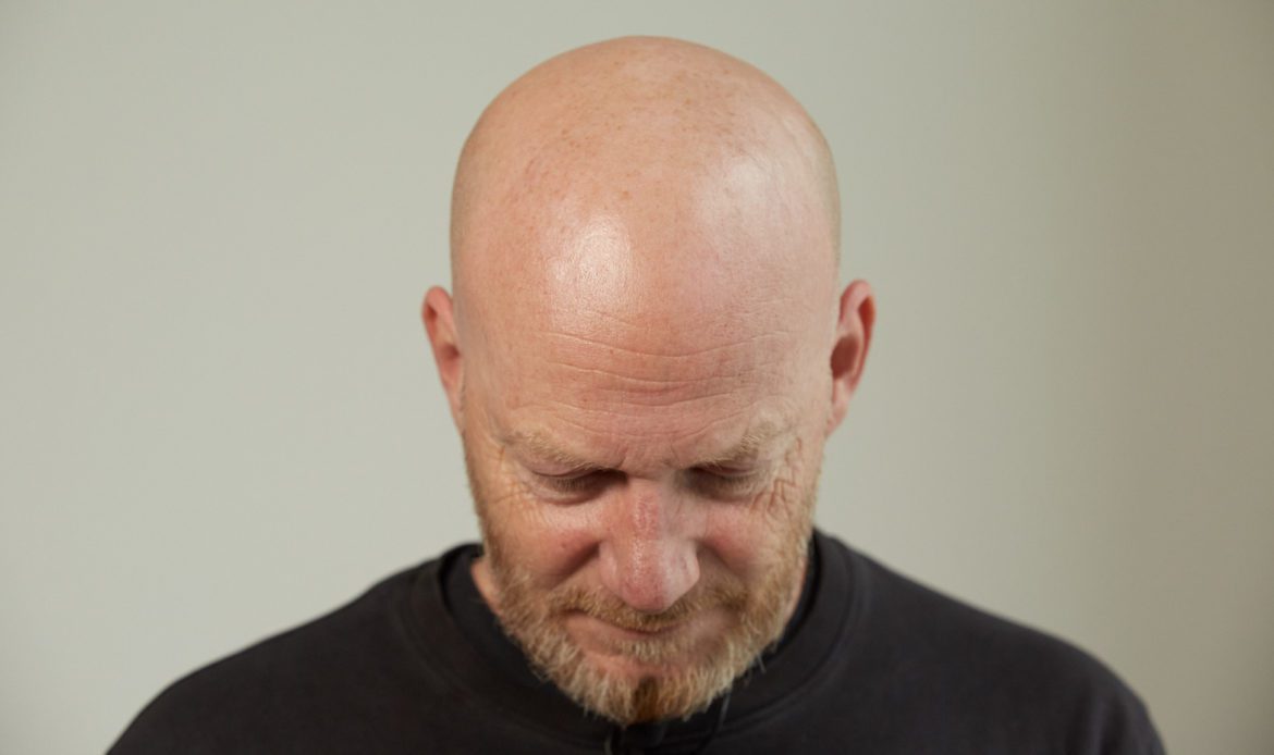 Mann mit Glatze vor der Behandlung bei Dr. Pigment von vorne oben