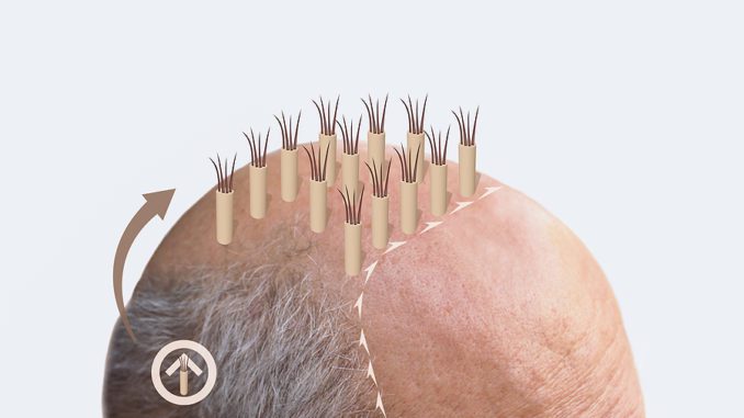 10 Gründe die für eine Haartransplantation sprechen