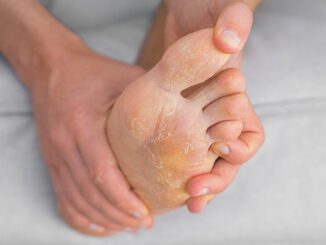 Trockene Füße Haut löst sich