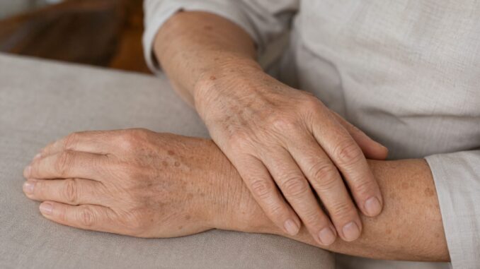 Hände einer älteren Frau mit Altersflecken als Beispiel für Hautveränderungen im Alter